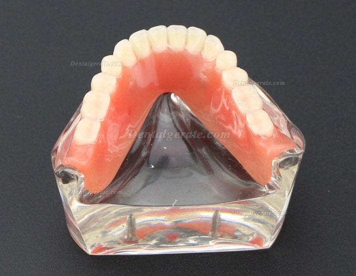 Modell f&uuml;r zahn&auml;rztliche Oberz&auml;hne Overdenture Superior 4 Implantate Demo Modell 6001 02